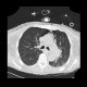 Pneumomediastinum, pneumothorax, PNO, subcutaneous emphysema: CT - Computed tomography